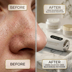Face Vacuum Suction Blackhead Remover Pore Cleaner